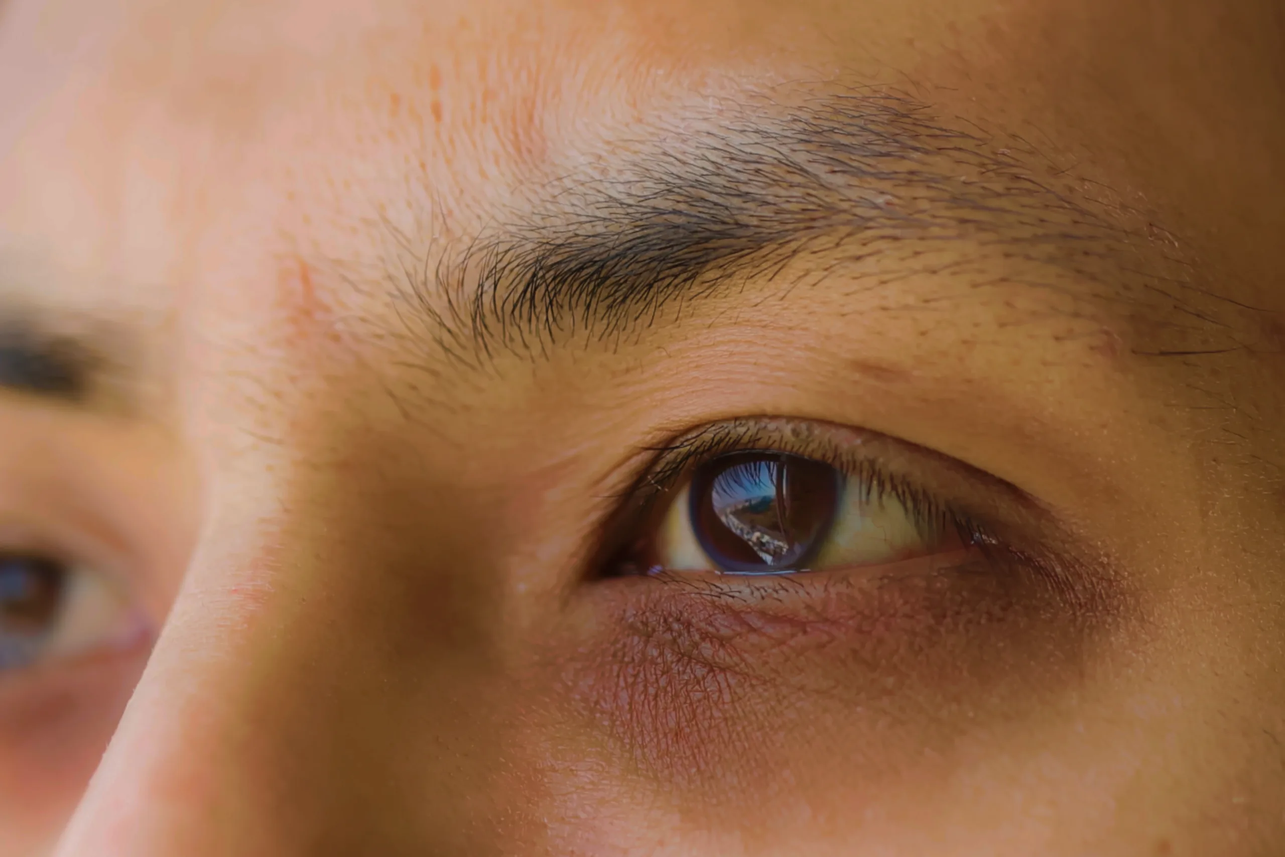 Dark Circles Treatment in Jubilee Hills, Hyderabad (1) Jubilee hills